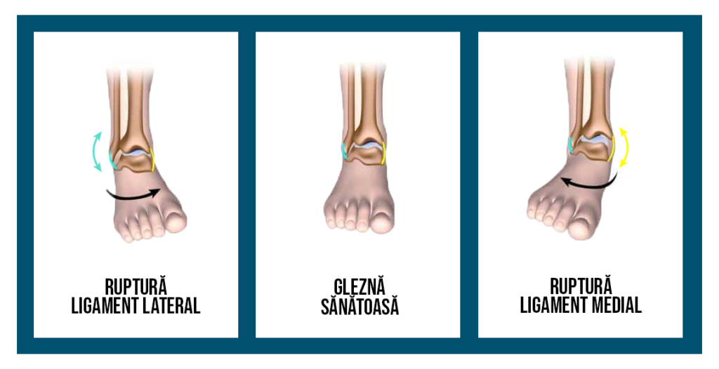 Dislocarea picioarelor în zona gleznei: ce trebuie să faceți? - Gută 