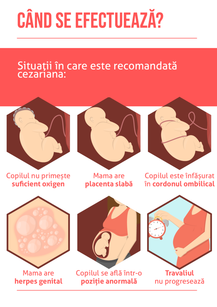 Secțiunea cezariană și varicoză - Varice uterine și secțiune prin cezariană