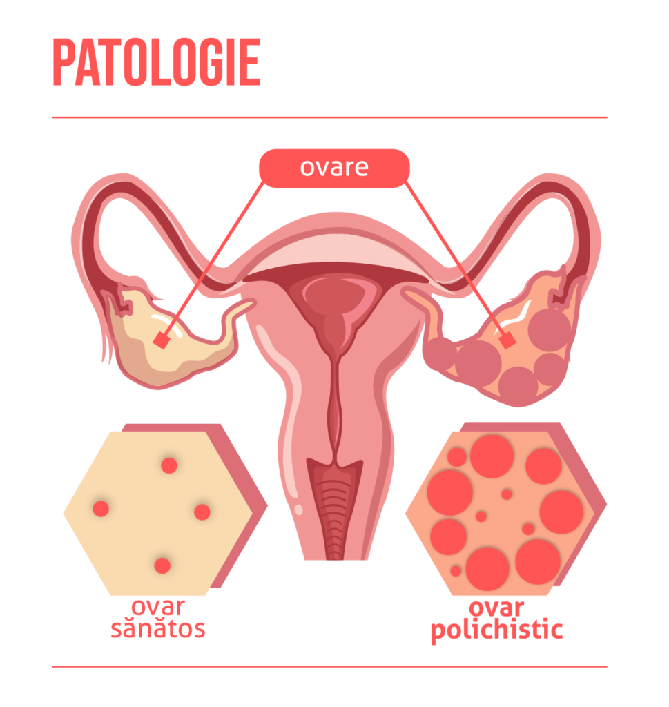 Patologia ovarelor polichistice