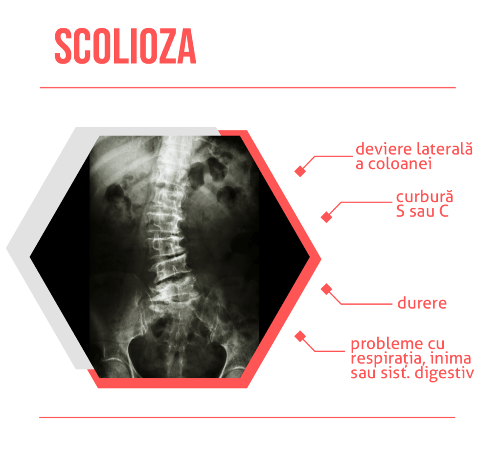 Scolioza