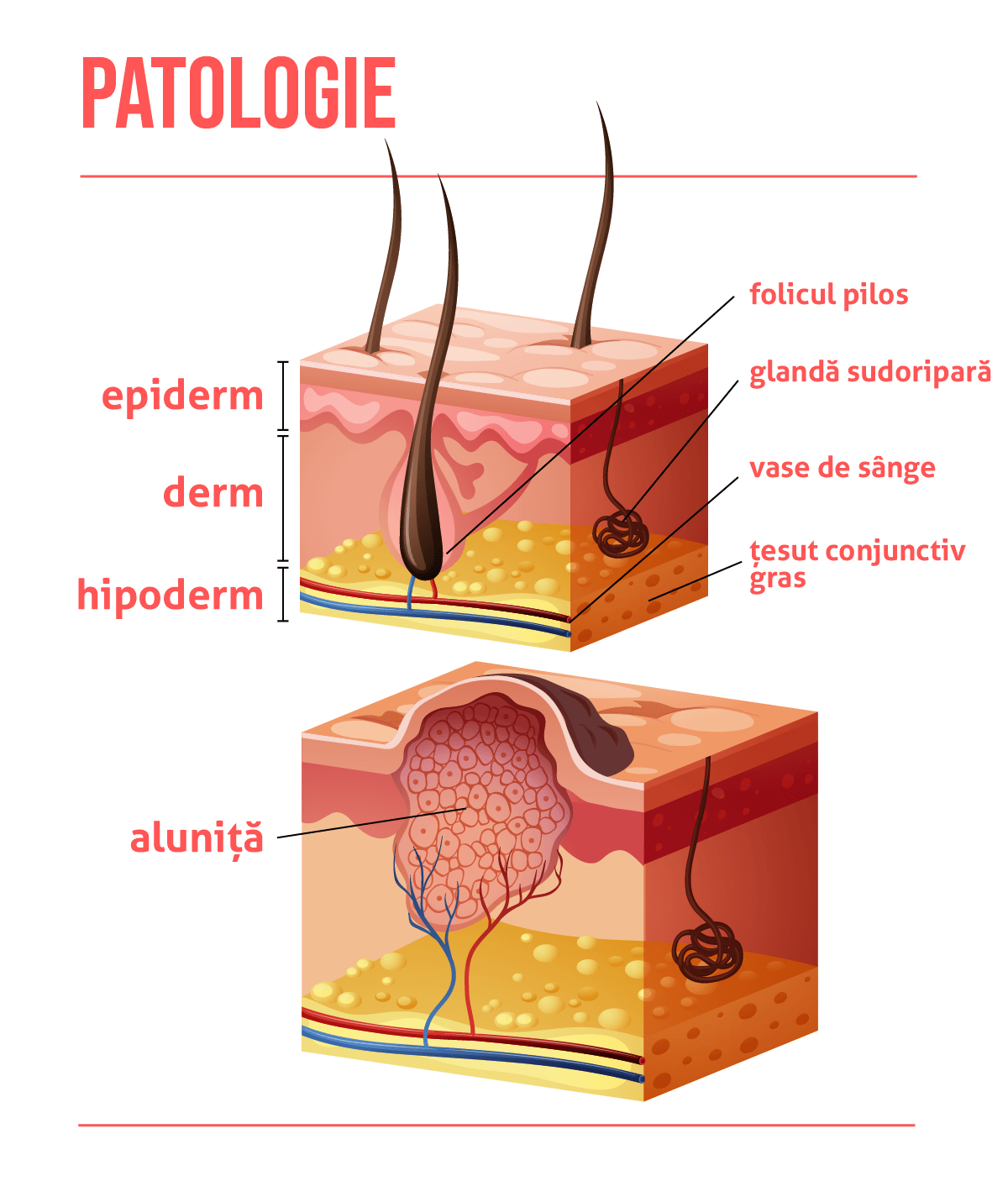 Cancer de col uterin