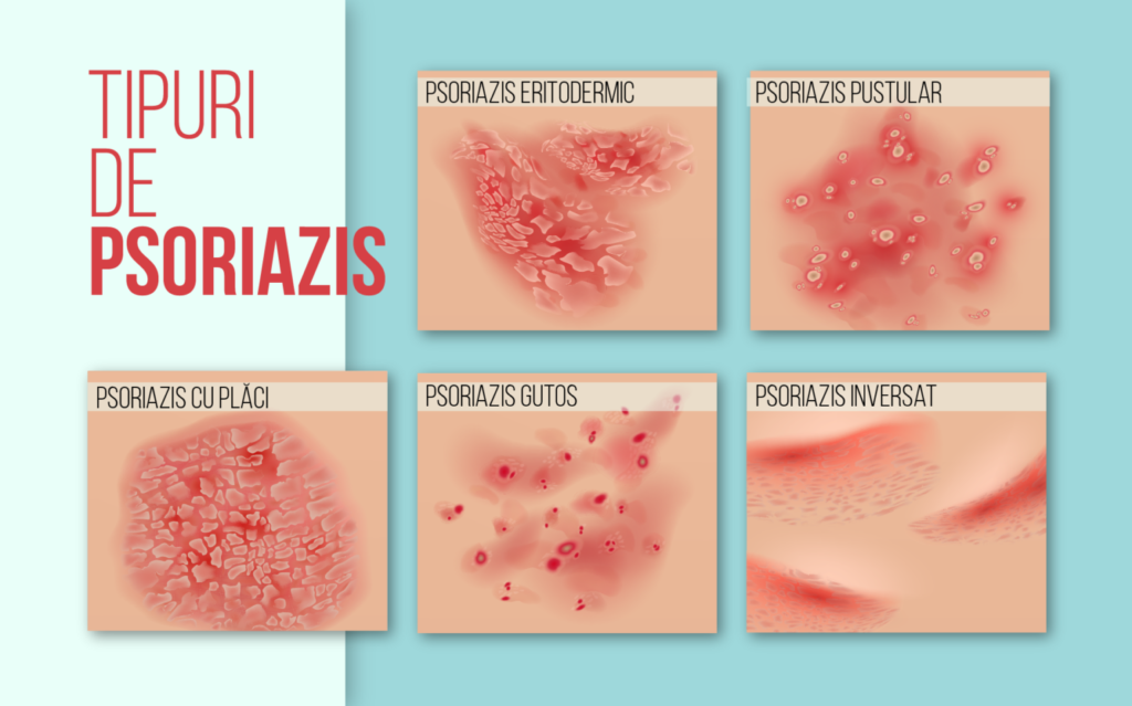 Tipuri psoriazis