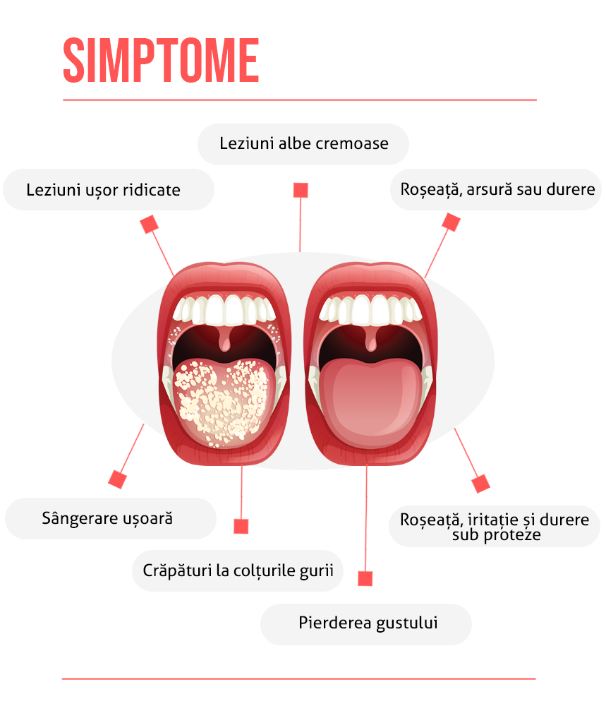 Simptome candidoza bucala