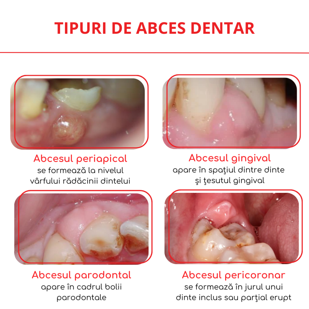 tipuri de abces dentar