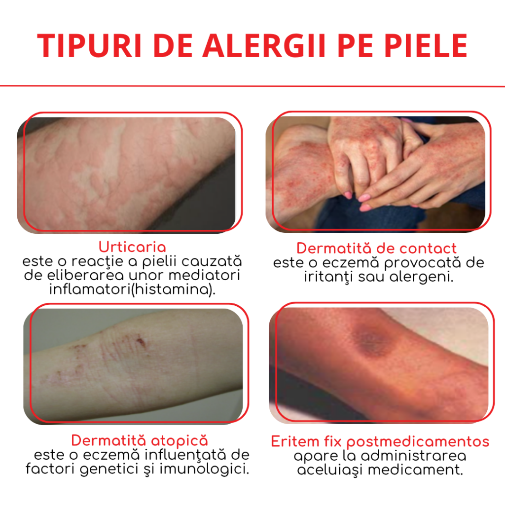 tipuri de alergii pe piele